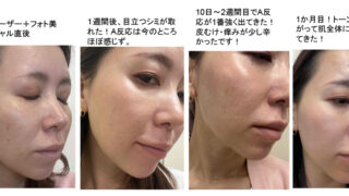 セラピューティック途中経過 | 名古屋 金山の美容皮膚科・美容外科